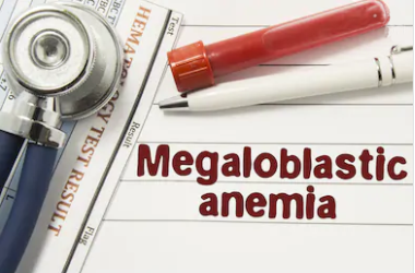 Megaloblastic-Anemia
