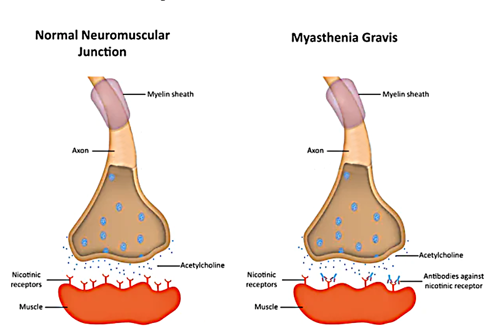 acetylcholine receptor myasthenia gravis