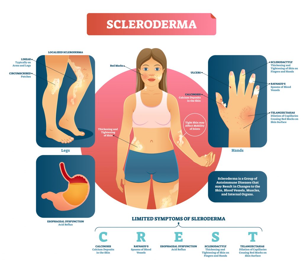 Scleroderma